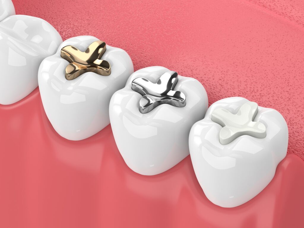 Three molar teeth with distinct dental fillings are depicted. The first tooth features a gold filling, the second has a silver amalgam filling, and the third displays a white composite filling. The teeth are embedded in a pink gum line.