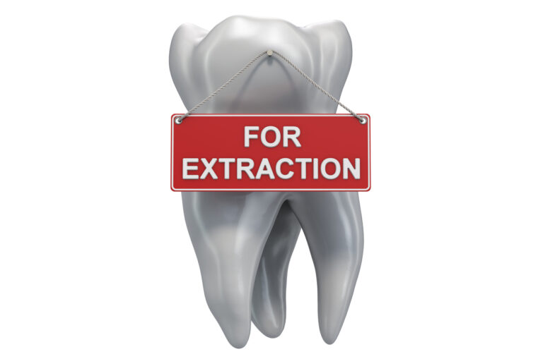 A detailed illustration of a tooth with a red sign hanging from it that reads 'FOR EXTRACTION,' attached by a string. The visual humorously represents a common dental procedure.